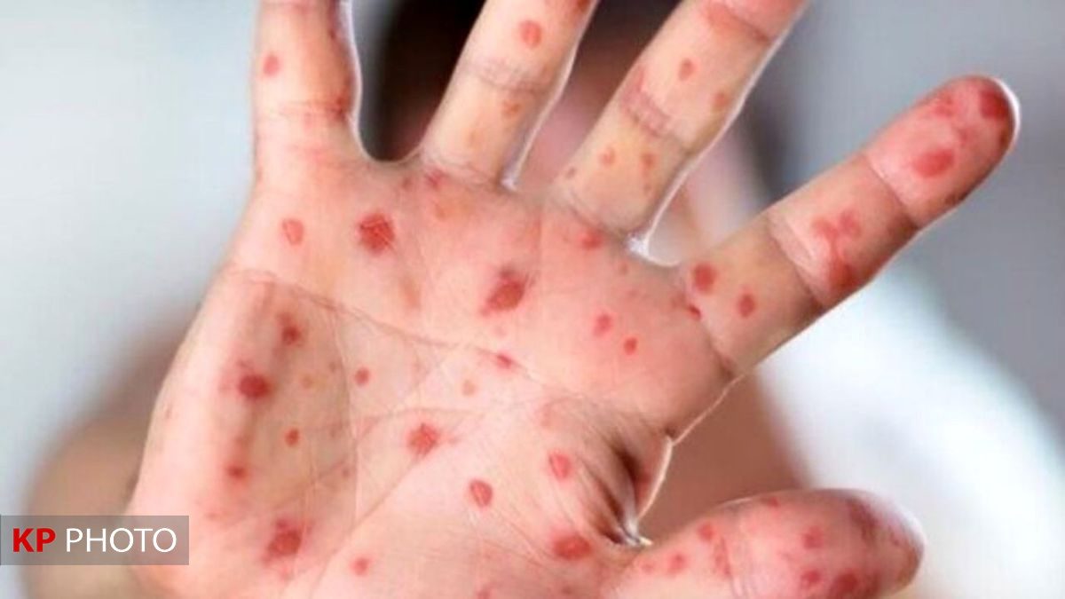 مشاهده ۲ مورد بیمار مشکوک به سرخک در آذربایجان غربی