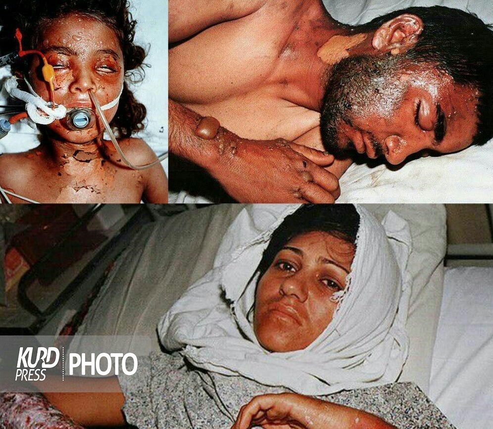 احراز تنها ١٥٠٠ مصدوم شیمیایی در سردشت / امکانات درمانی کافی نیست!