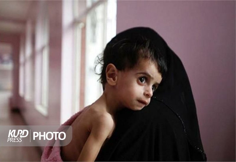 15 درصد کودکان کردستانی از سوءتغذیه رنج می برند