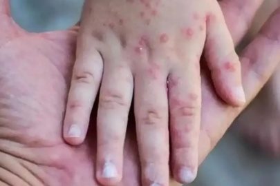 ترکیه تدابیر ویژه ای را علیه همه گیری آبله میمونی در فرودگاه استانبول اتخاذ کرد